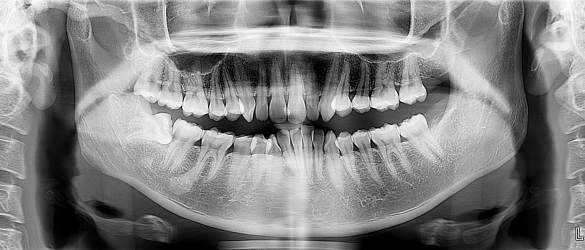 Wisdom Tooth Removal